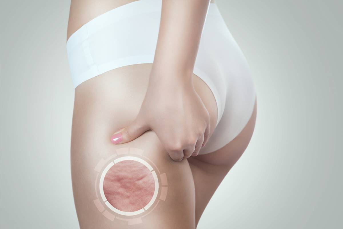 Les meilleurs ingrédients naturels pour se débarrasser de la cellulite